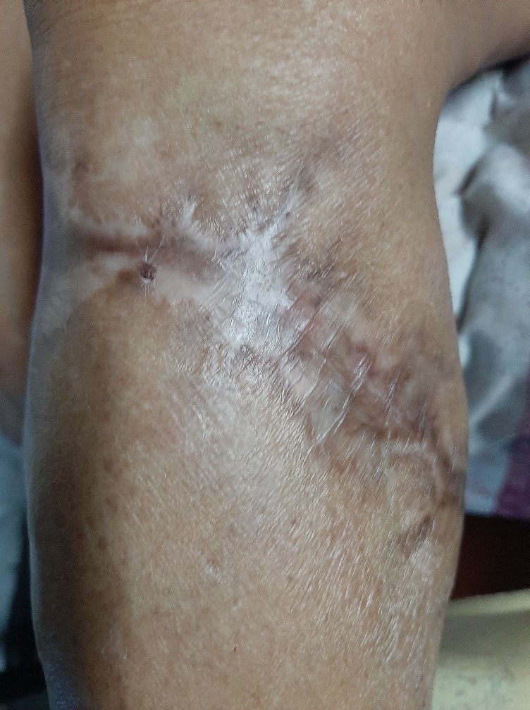 ML, 63/F, diabetic, with a large, infected, non-healing ulcer on her proximal leg.