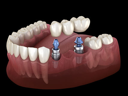 Implant Supported Bridge - Title Photo.j