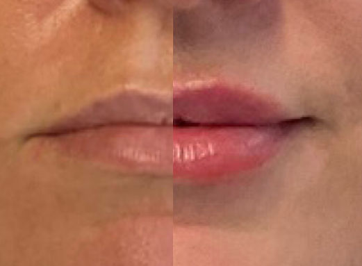 Natural looking lip filler 