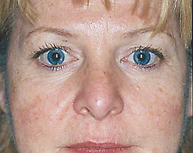 vb_facial telangiectasia_Thomas E. Rohre