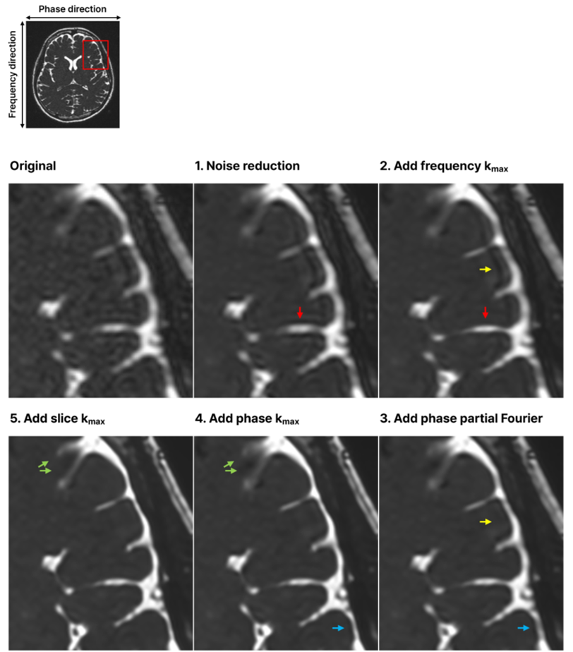 Deep Learning di SwiftMR (AI per risonanza magnetica)
