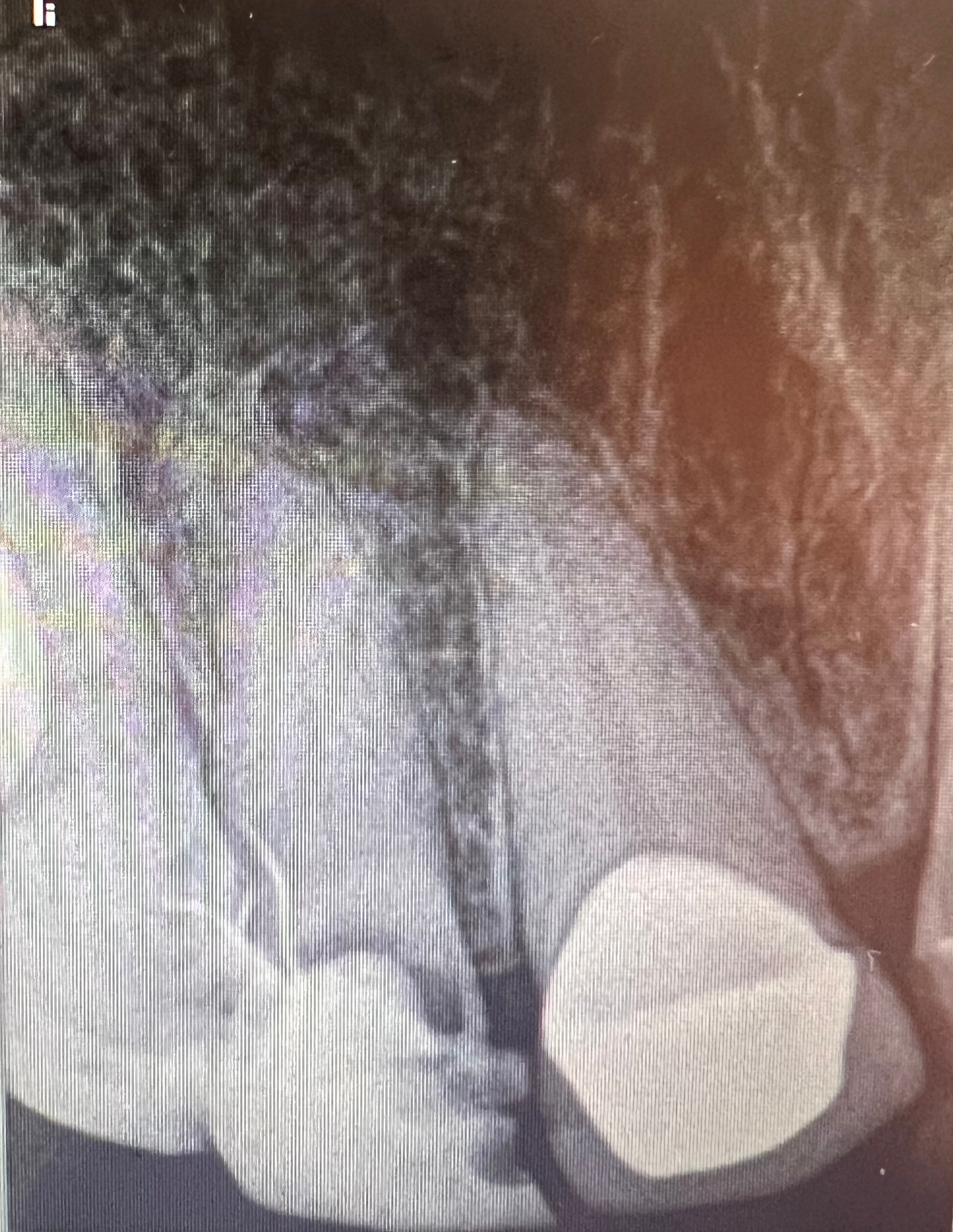 LATERAL AESTHETIC IMPLANT NEOBIOTECH ISIII + LAB DESIGN content media