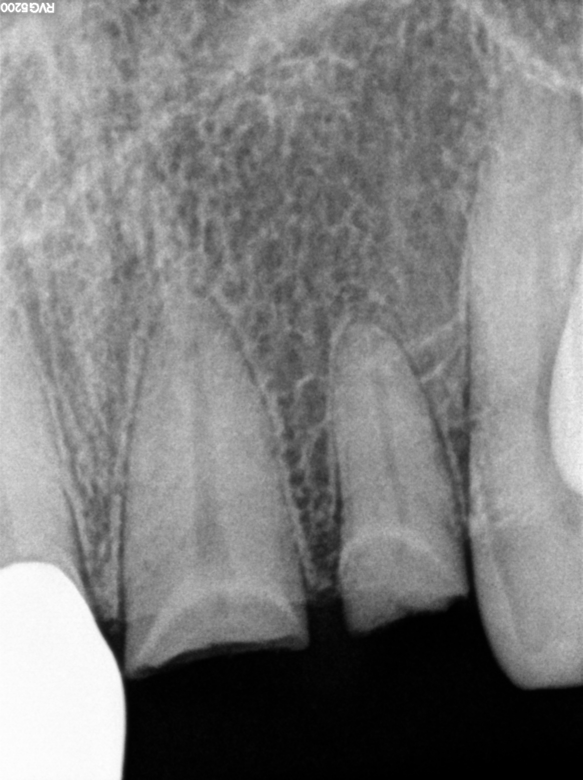 DENTAL FRACTURE ! NEOBIOTECH ISII IMPLANTS IN LATERAL AND CENTRAL TOOTHS content media