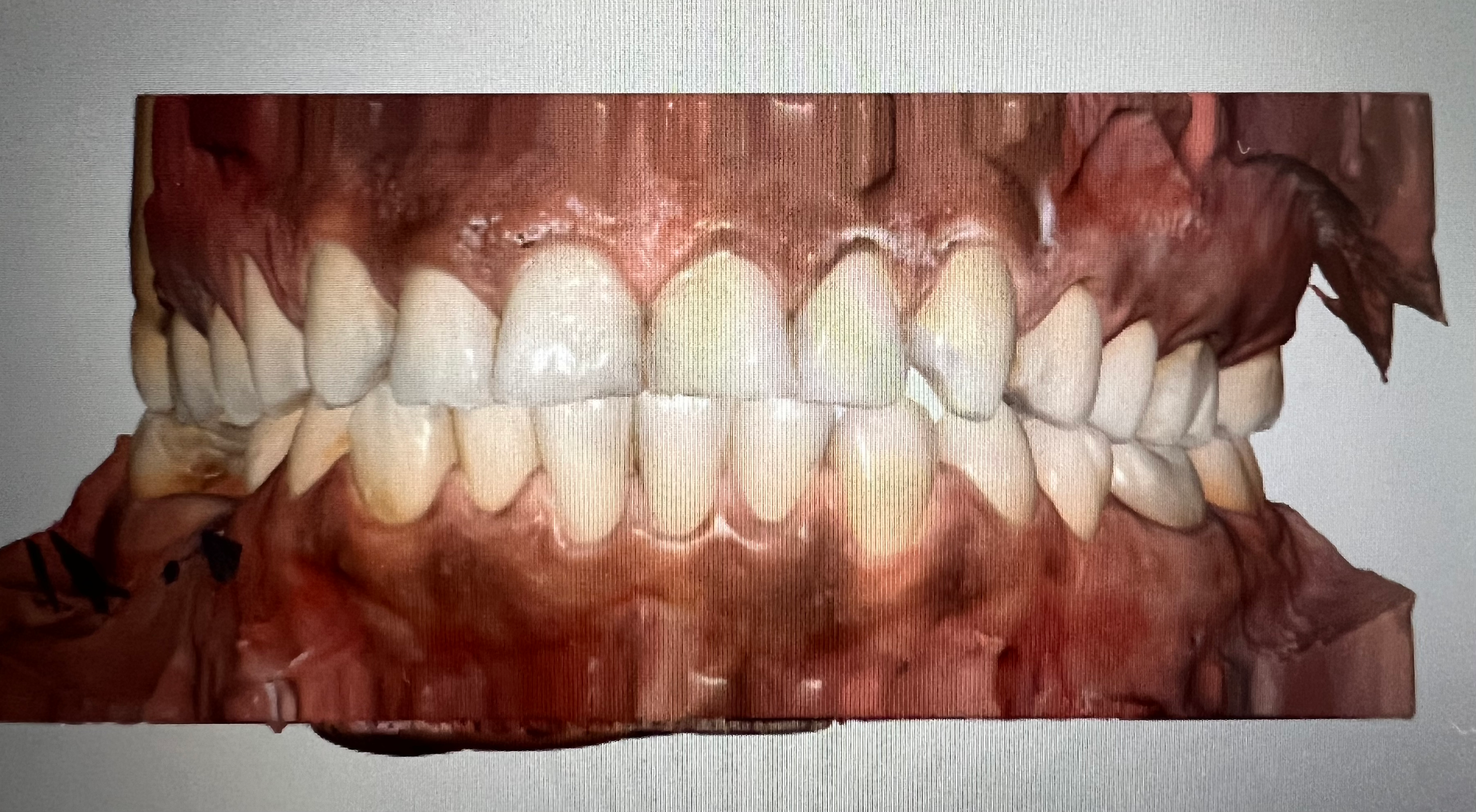 RX STEP BY STEP NEOBIOTECH IMPLANT ISII IN MOLAR ZONE + MEDIT SCAN content media