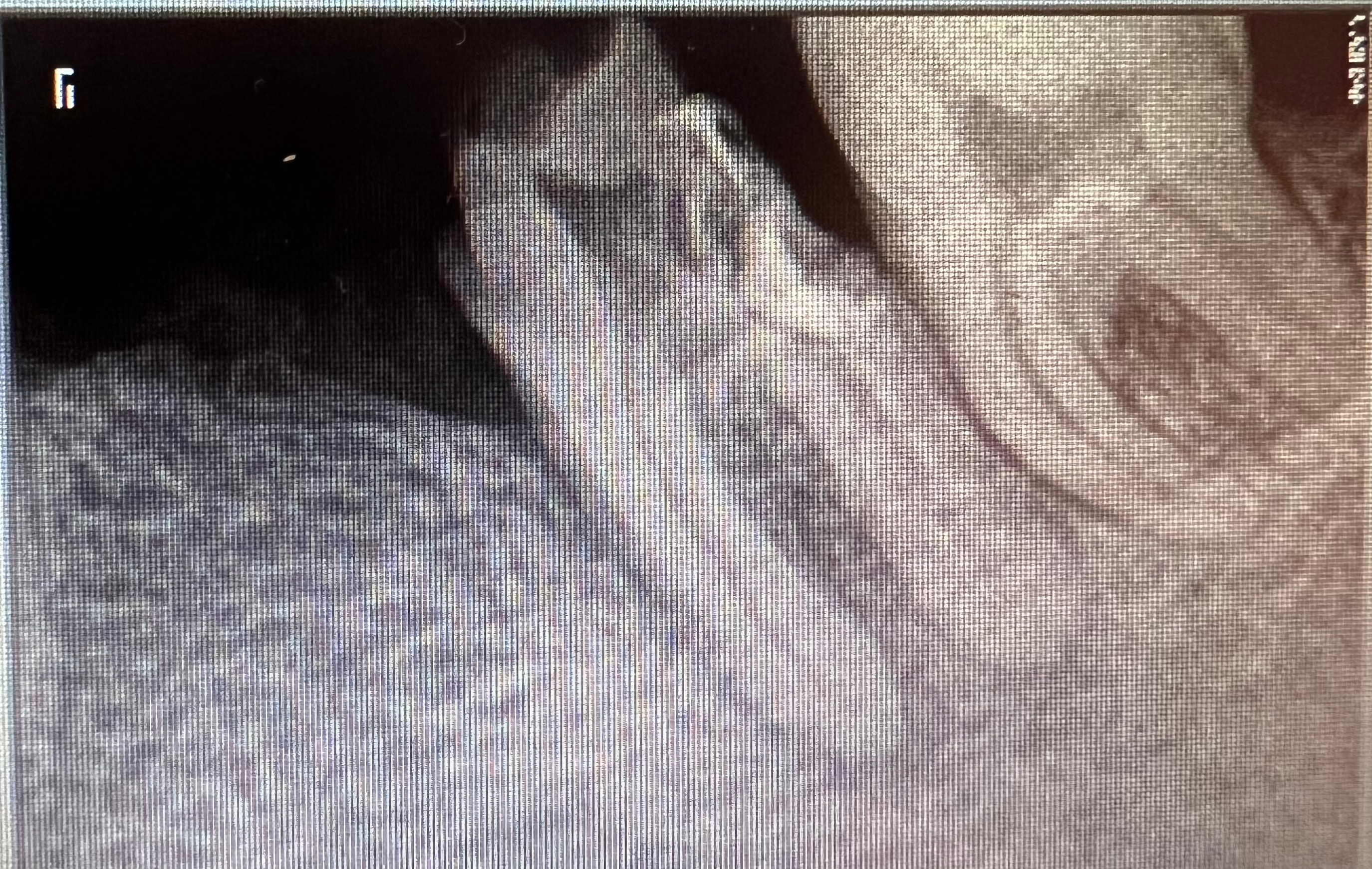 PREMOLAR IMPLANT WITH NEOBIOTECH ISII ACTIVE + MEDIT SCAN + LAB DESIGN content media