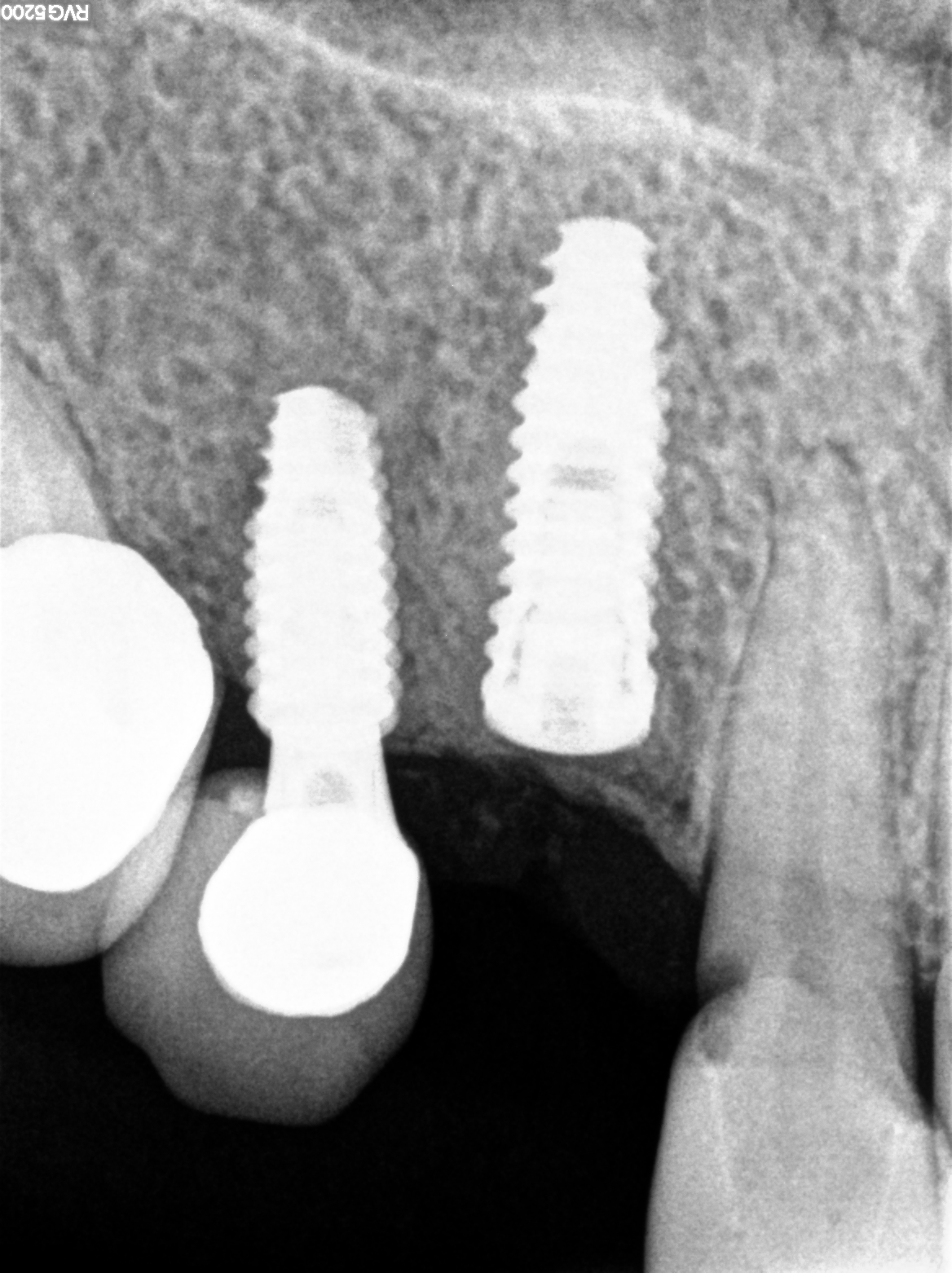AESTHETIC LATERAL NEOBIOTECH ISII ACTIVE IMPLANT + MEDIT SCAN + LAB DESIGN content media
