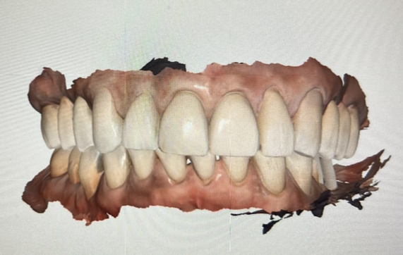 TWO JAW MOLAR NEOBIOTECH ISIII IMPLANTS + MEDIT SCAN + LABORATORY DESIGN content media