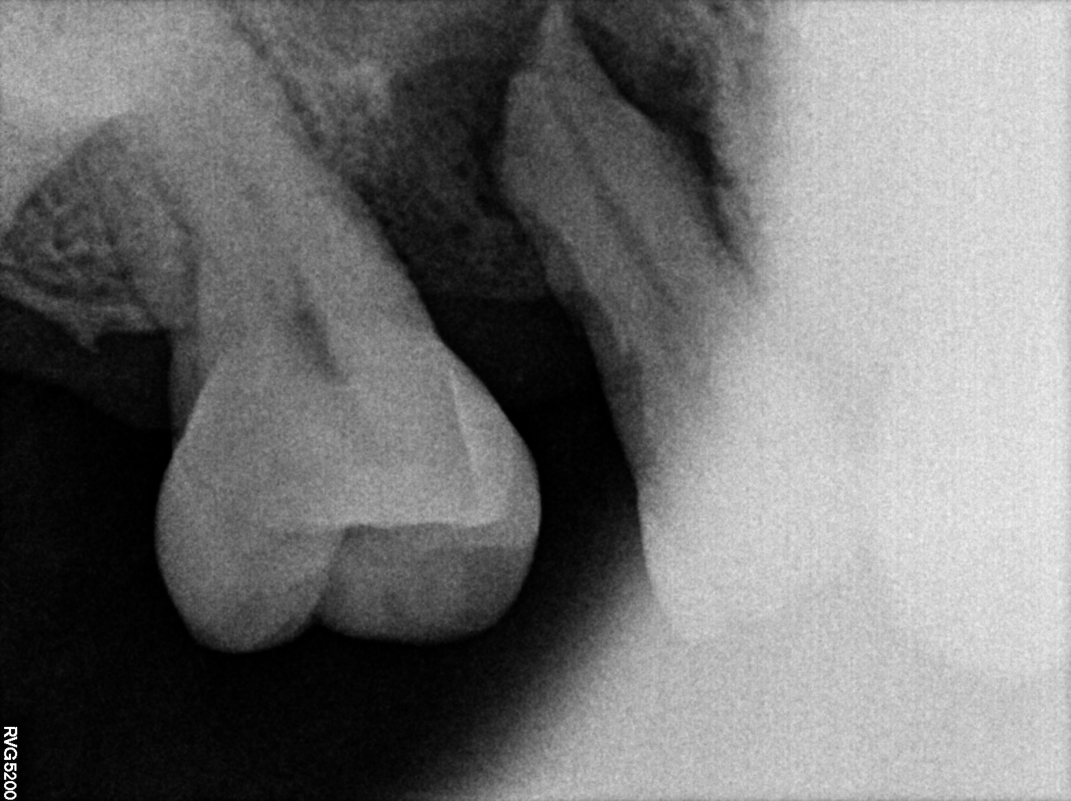SINGLE NEOBIOTECH ISII ACTIVE IMPLANT STEP BY STEP + MEDIT SCAN + LAB DESIGN content media