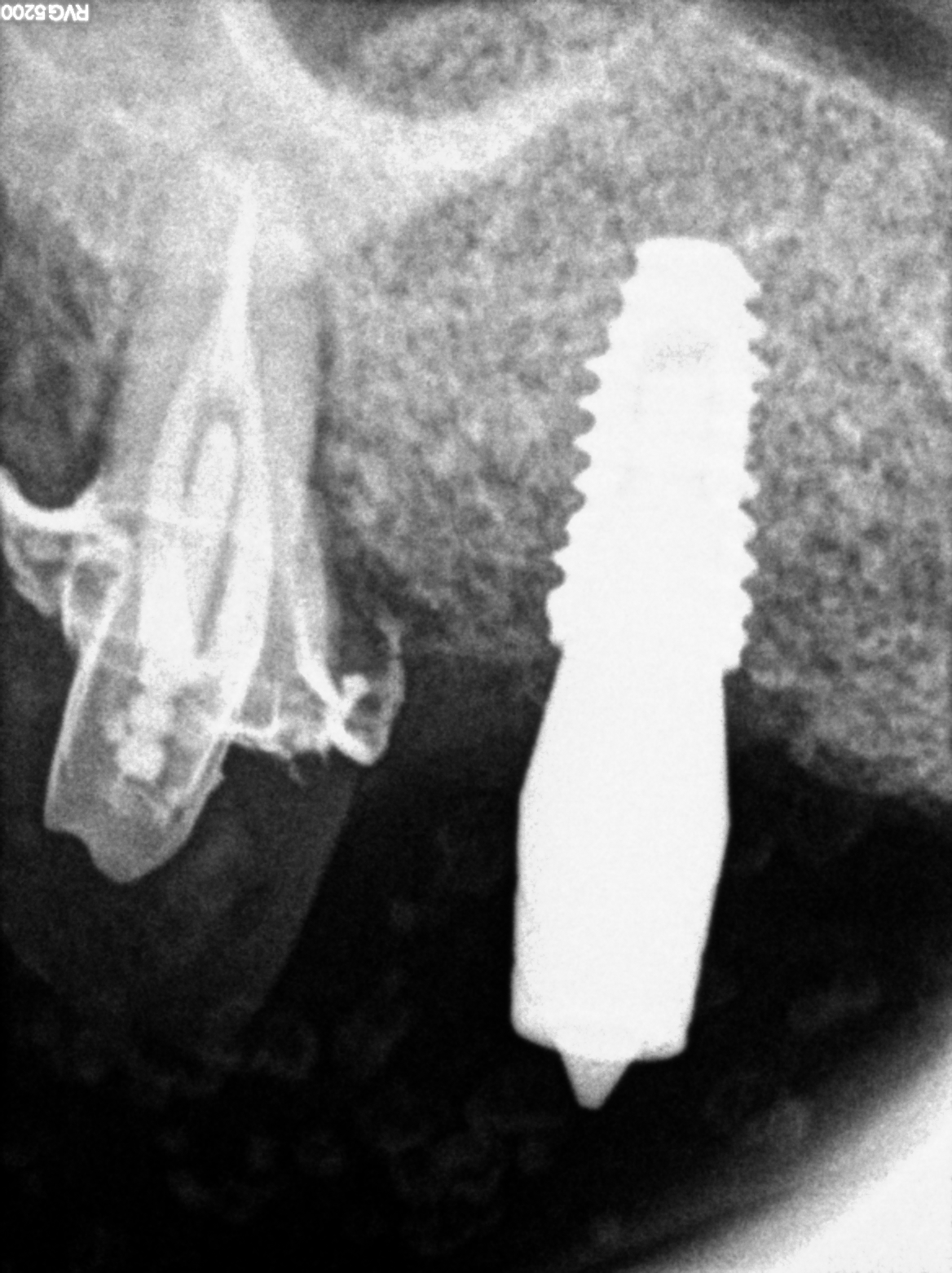 MAXILLA IMPLANT BRIDGES WITH NEOBIOTECH ISII IMPLANTS + MEDIT SCAN + LAB DESIGN content media