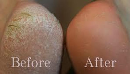 How-to-cure-cracked-heels-FAST.jpg