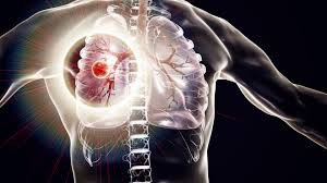 Tuberculose traitement naturel