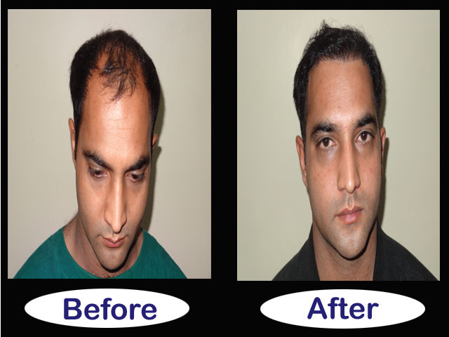 Hair Transplantation