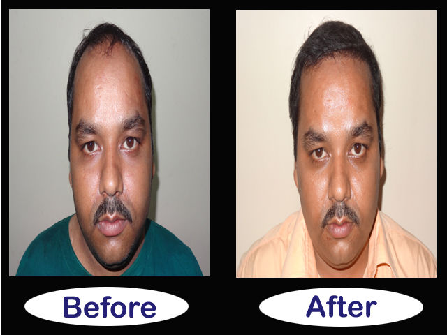 Hair Transplantation