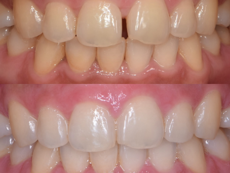 에어라인 교정으로 치간이개(치아사이벌어짐) 해결했어요.