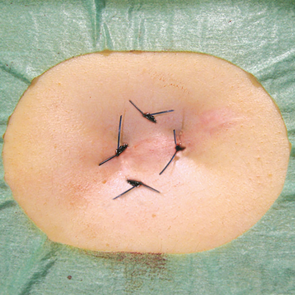 Freka PEG Pro Gastric with Insertion Kit: PEG 14 FR