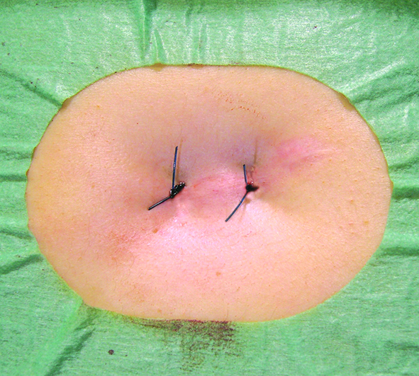 Freka PEG Pro Gastric with Insertion Kit: PEG 14 FR