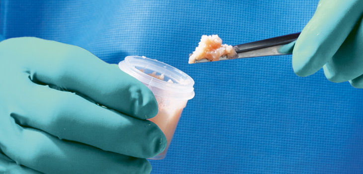 Bone Bank Allografts | MediSol