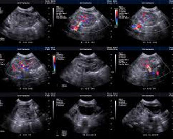 Ecografia apparato urinario con Doppler – diagnosi di calcoli e patologie renali a Messina