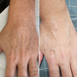 Hands Rejuvination