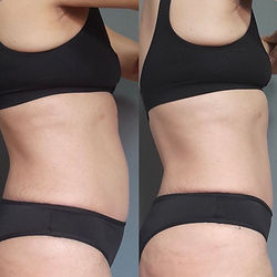 Lymphatic drainage