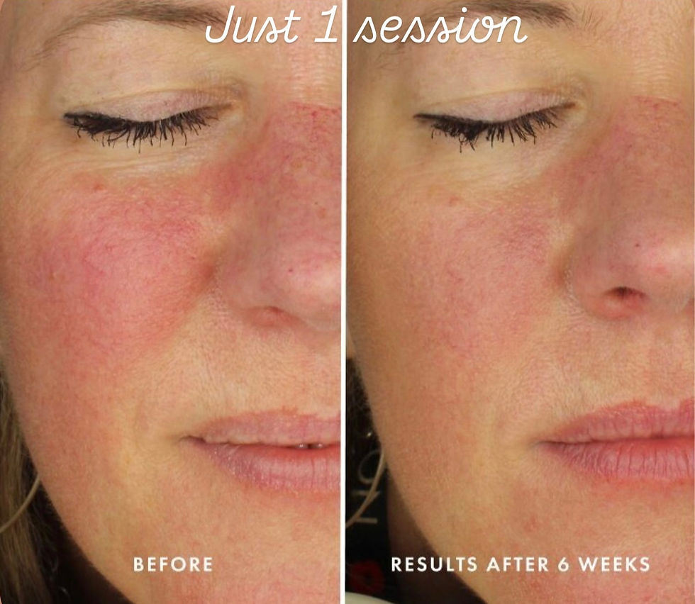 rosacea treatment