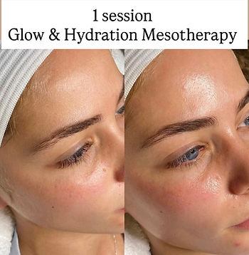 Mesotherapy Basingstoke