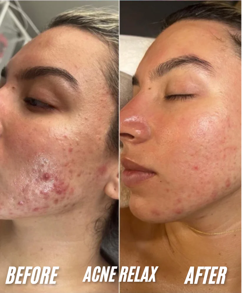 CO2 bubble facial