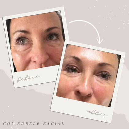 Facial Basingstoke
