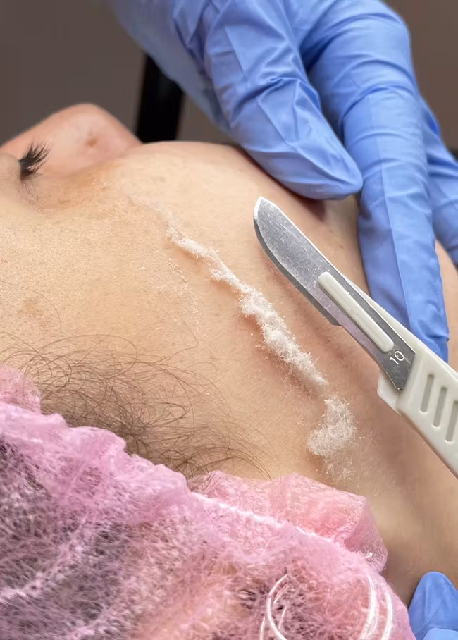 Dermaplaning