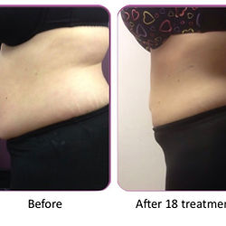 Lymphatic Drainage