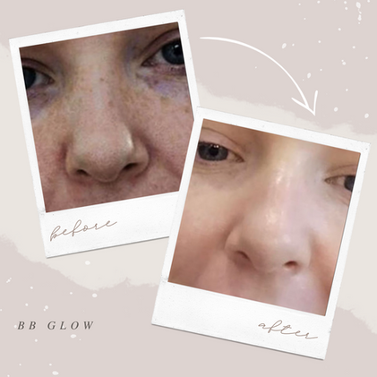 Facial Basingstoke