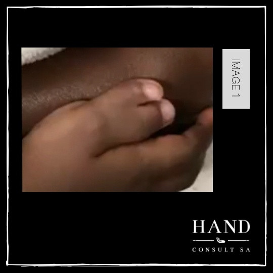 Thumb Polydactyly