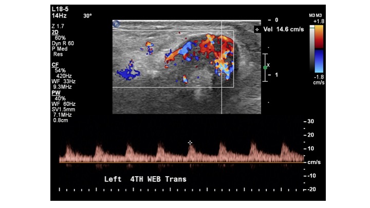 Rare Lipoma of the Tendon Sheath of the Fifth Extensor Compartment of the Hand