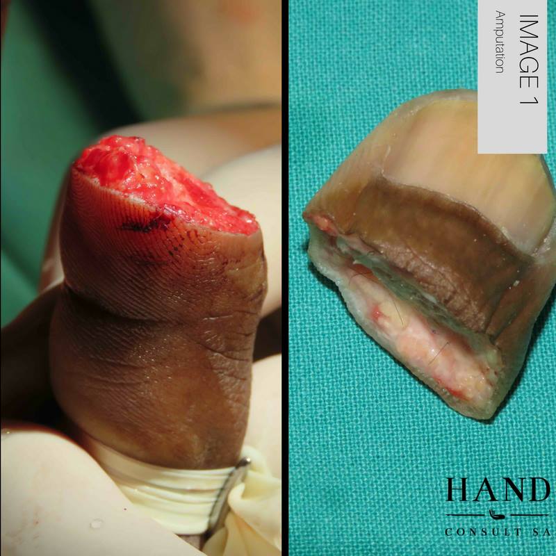 Thumb Re-Plantation