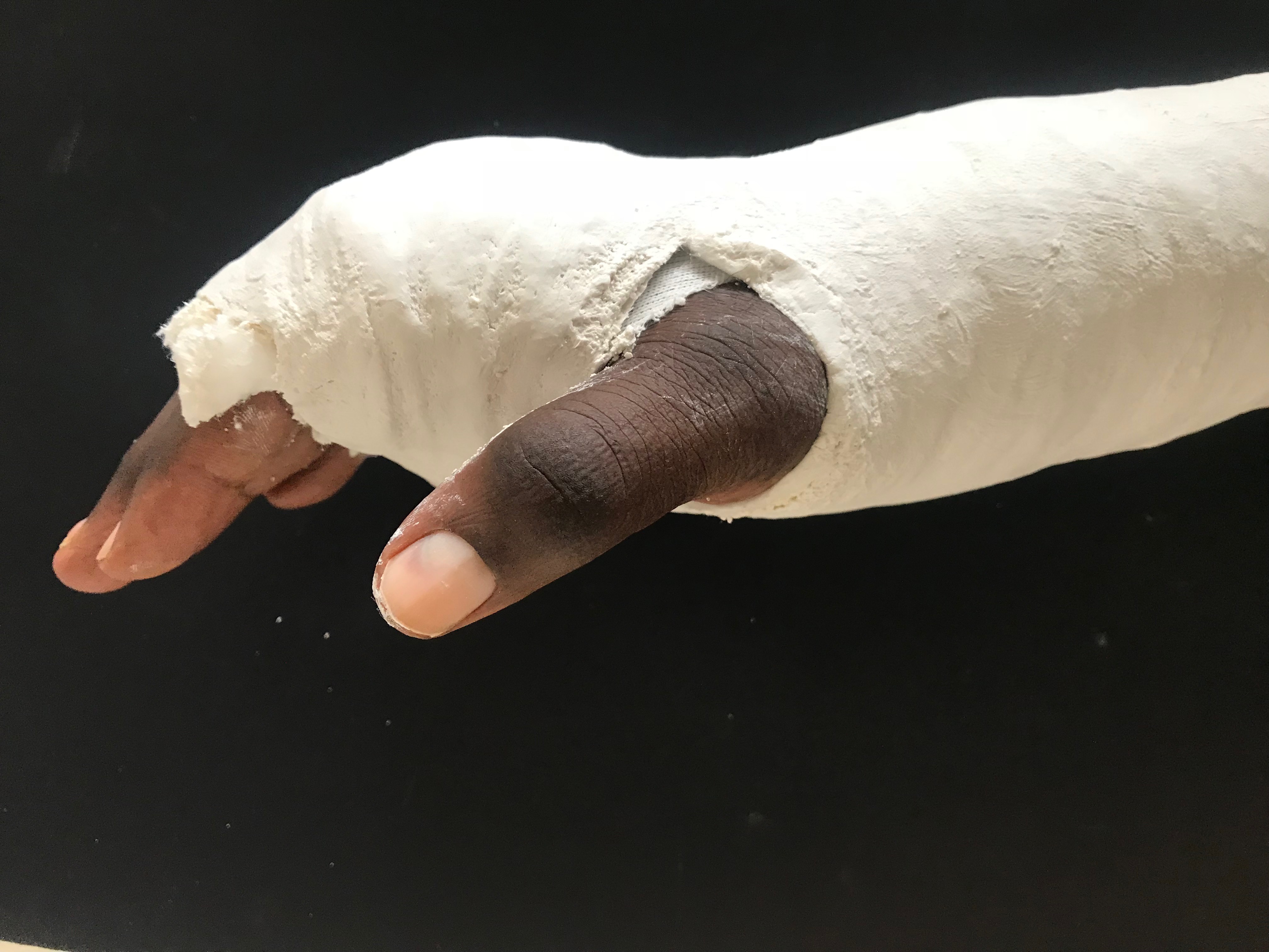 Fireworks Injury - CMMS Treatment