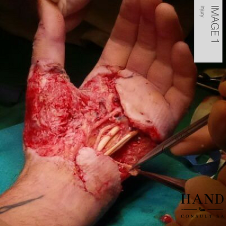 Crush & Degloving Injury of the Hand