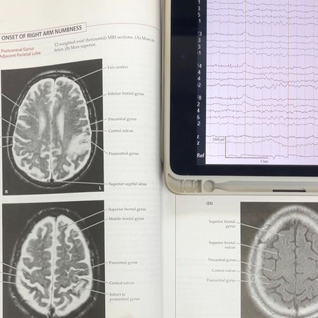 What shows up on an EEG if a patient has had a stroke?