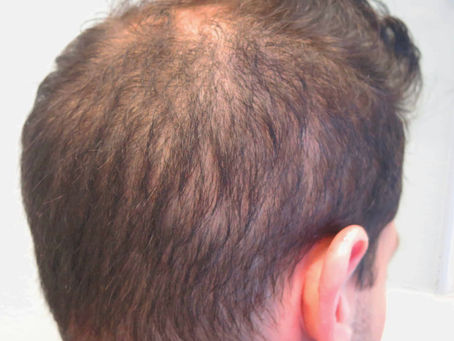 Why DUPA Sufferers Should Consider Scalp Micropigmentation over Hair Transplants