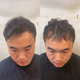 Thinning Hair restoration through Scalp micropigmentation
