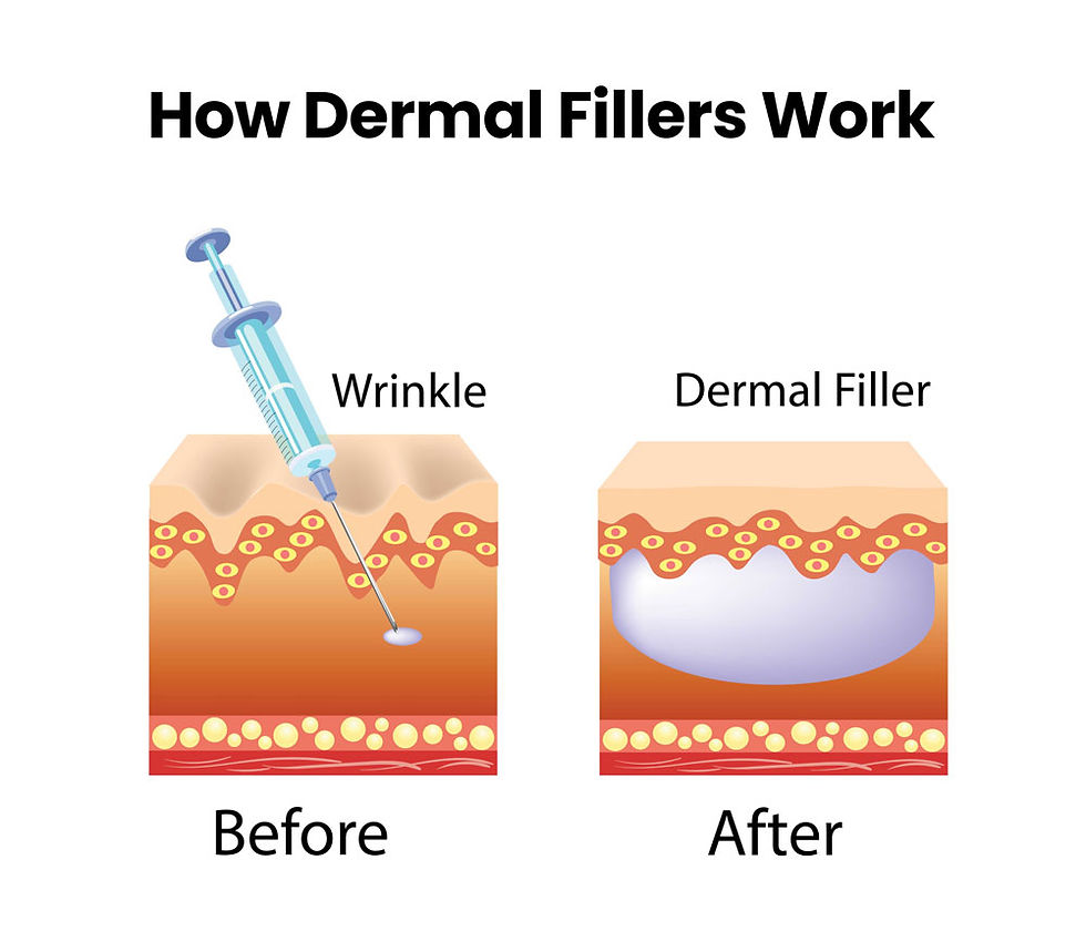 How Dermal Fillers Work