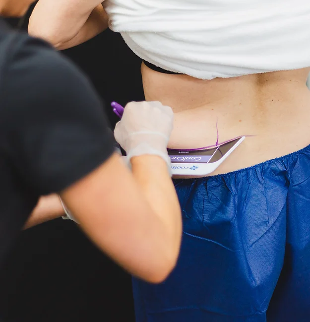 CoolSculpting Treatment for love handles