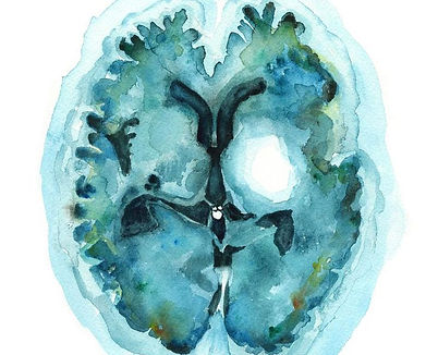 Hemorrhagic Stroke Watercolor Print Neurology Art Teal Painting Anatomy Art Print Brain Ar