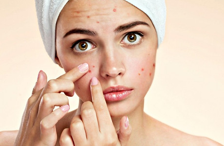 acne-shutterstock-770x470.jpg
