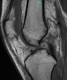 No ACL.png