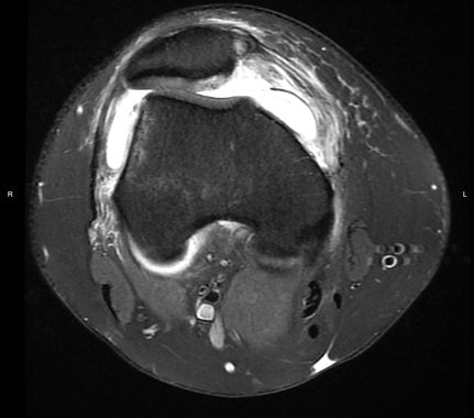 MPFL tear MRI.jpg