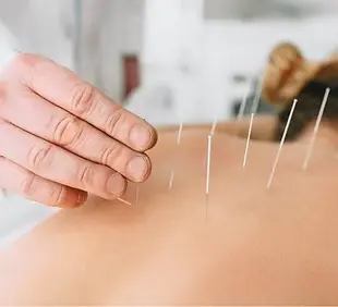 dry needle.webp