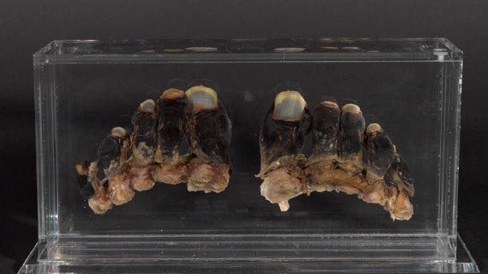 Bronco's toes have been on display all over the world. They were removed after severe frost bit while climbing the North Ridge.