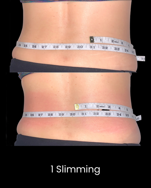 Cryoskin Slimming Before and After