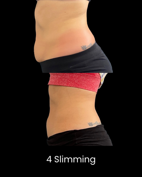 Cryoskin Slimming Before and After
