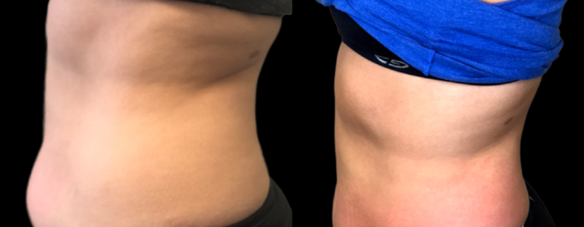 Before and After Cryoskin Toning - CryoToning